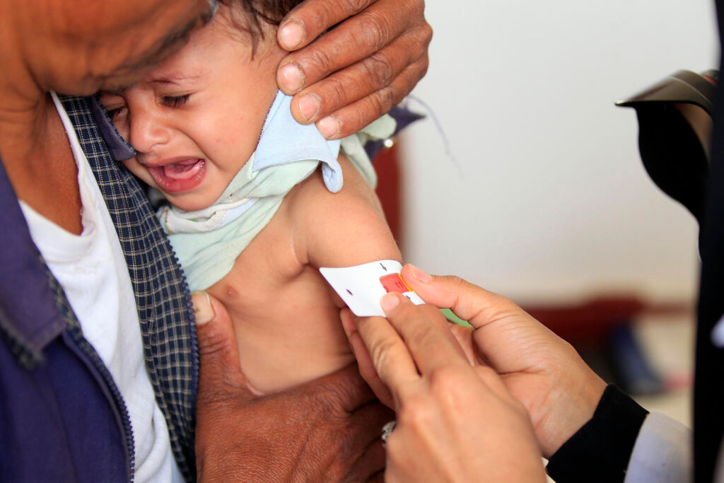 Lääkäri mittaa jemeniläisen Yahya Hamoud Ali Al Huzefin käsivartta, koska 9 kuukautta vanha Yahya kärsii aliravitsemuksesta. Hän sai hoitoa UNICEFin tuella sairaalassa Sanaan laitamilla 30. lokakuuta 2018. (c) Mohammed Huwais